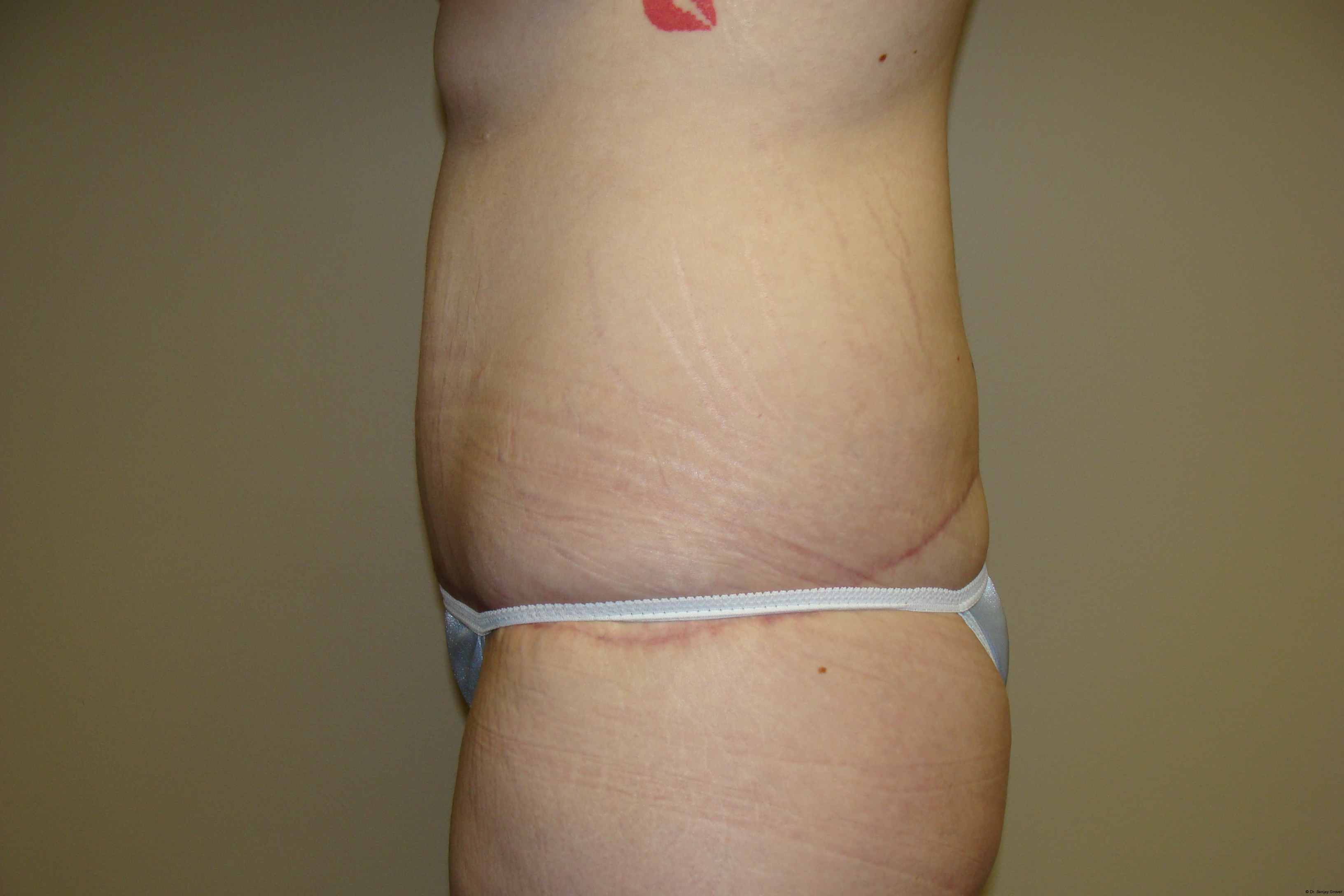 Tummy Tuck Before and After 19 | Grover Aesthetics