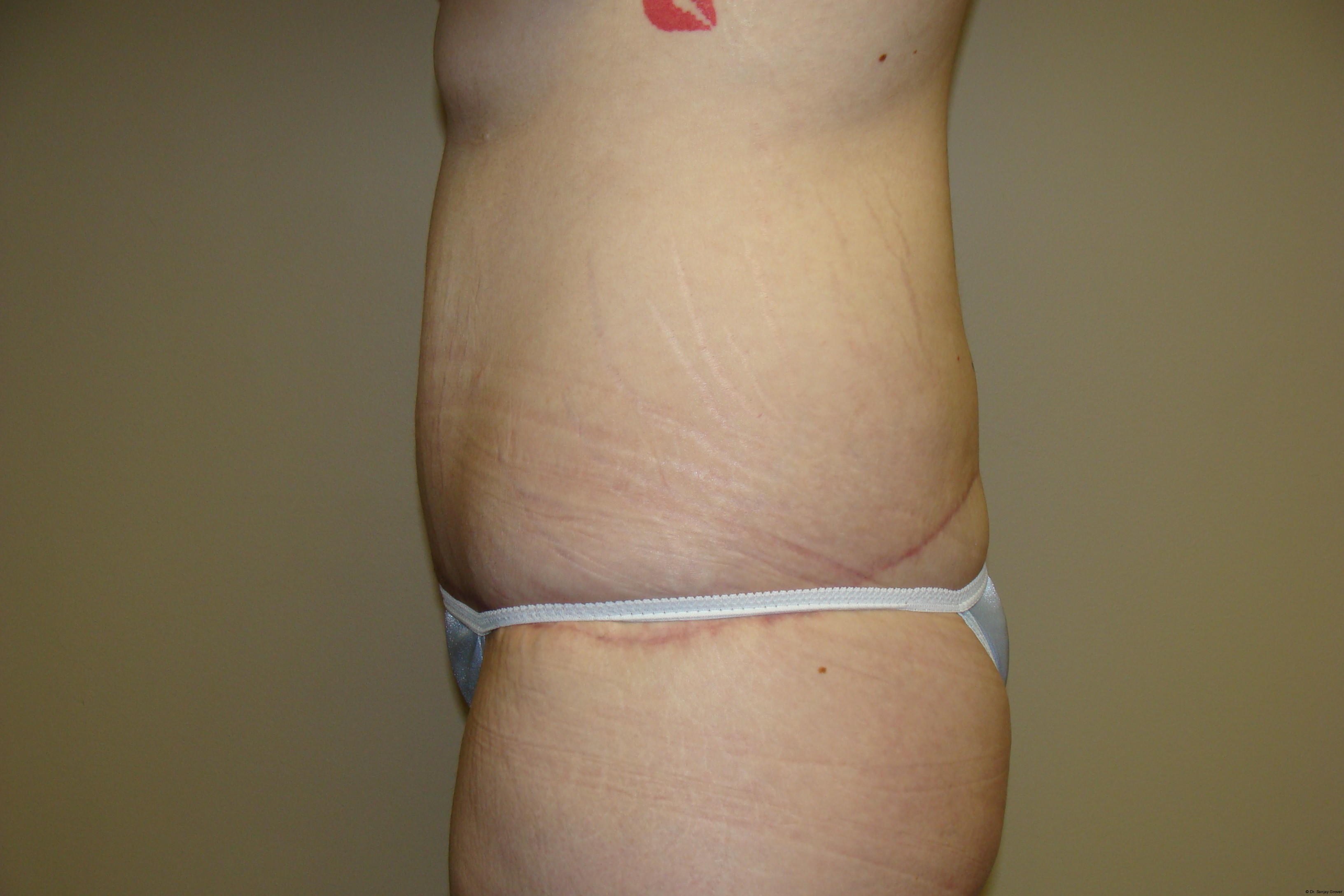 Tummy Tuck Before and After 19 | Sanjay Grover MD FACS