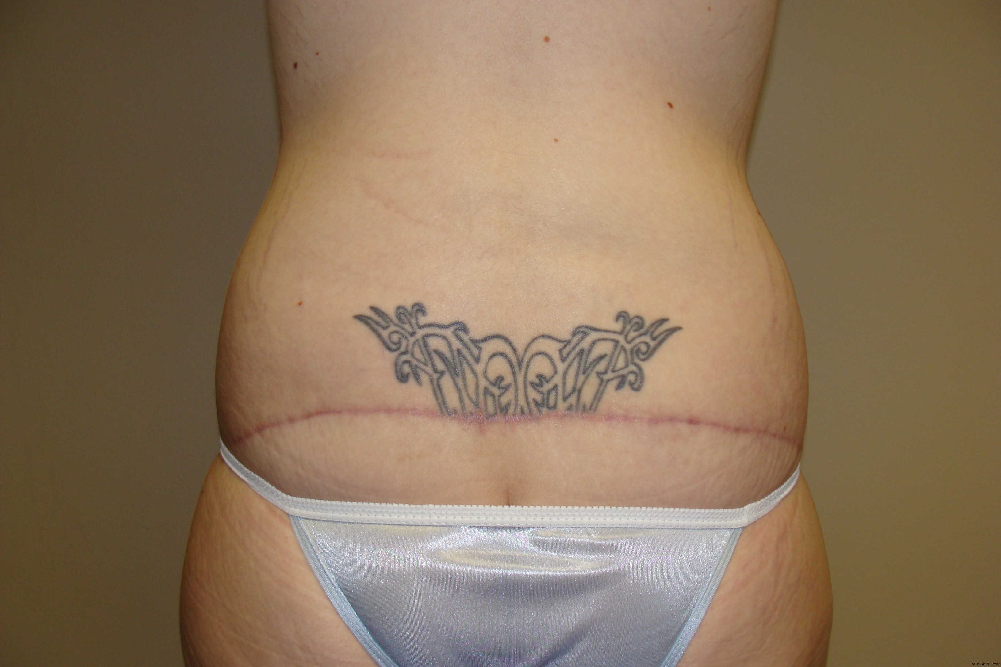 Tummy Tuck Before and After 19 | Grover Aesthetics