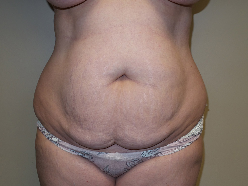 Tummy Tuck Before and After | Grover Aesthetics
