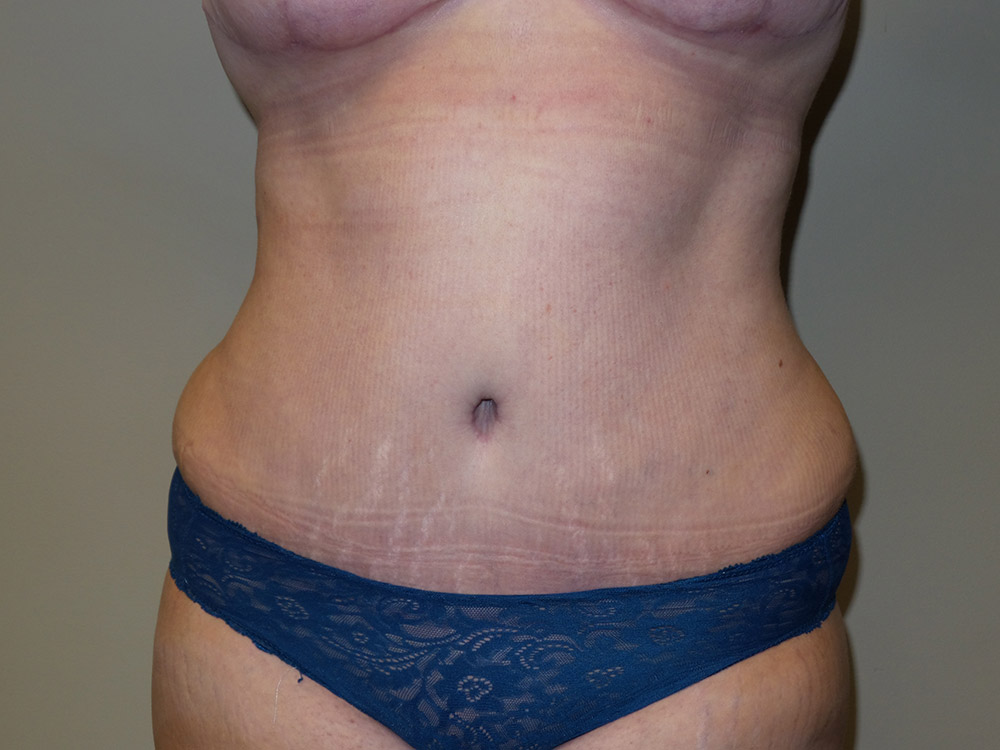 Tummy Tuck Before and After | Grover Aesthetics