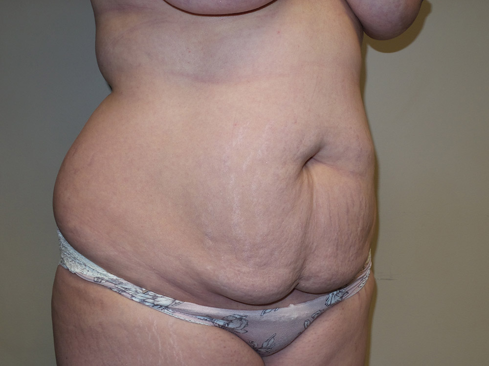 Tummy Tuck Before and After 20 | Grover Aesthetics