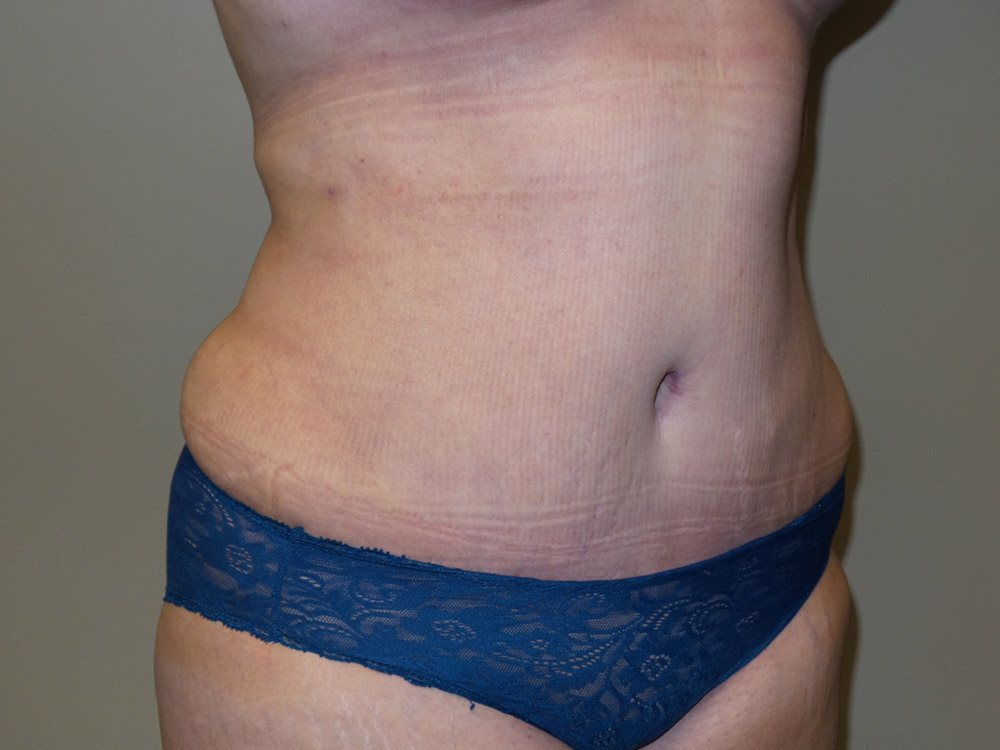 Tummy Tuck Before and After 20 | Sanjay Grover MD FACS