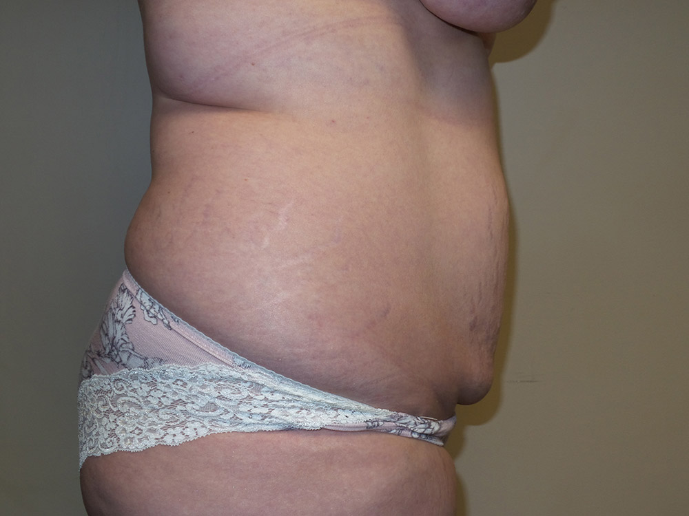 Tummy Tuck Before and After 20 | Sanjay Grover MD FACS