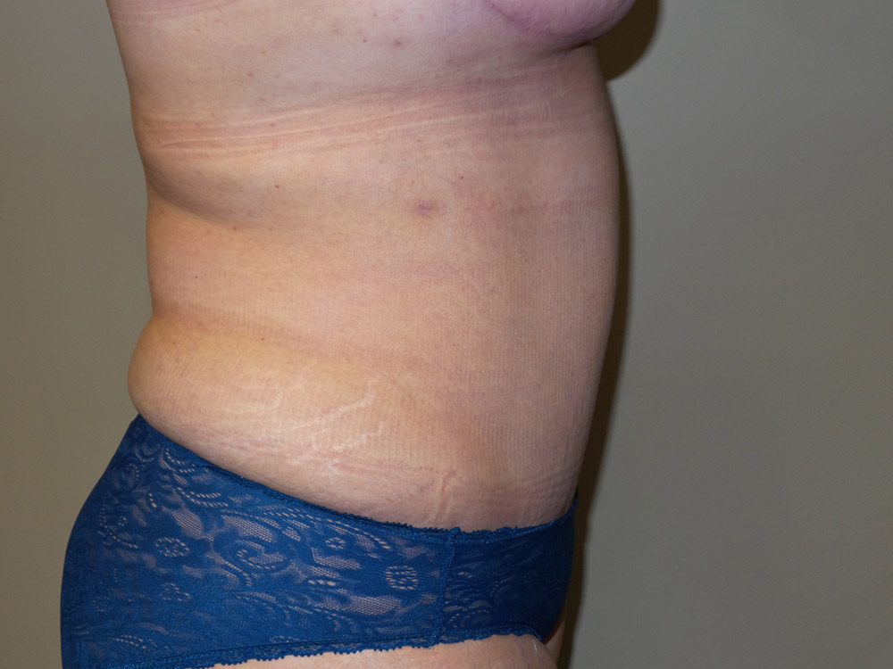 Tummy Tuck Before and After 20 | Sanjay Grover MD FACS