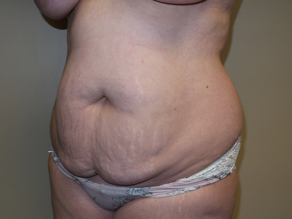 Tummy Tuck Before and After 20 | Grover Aesthetics