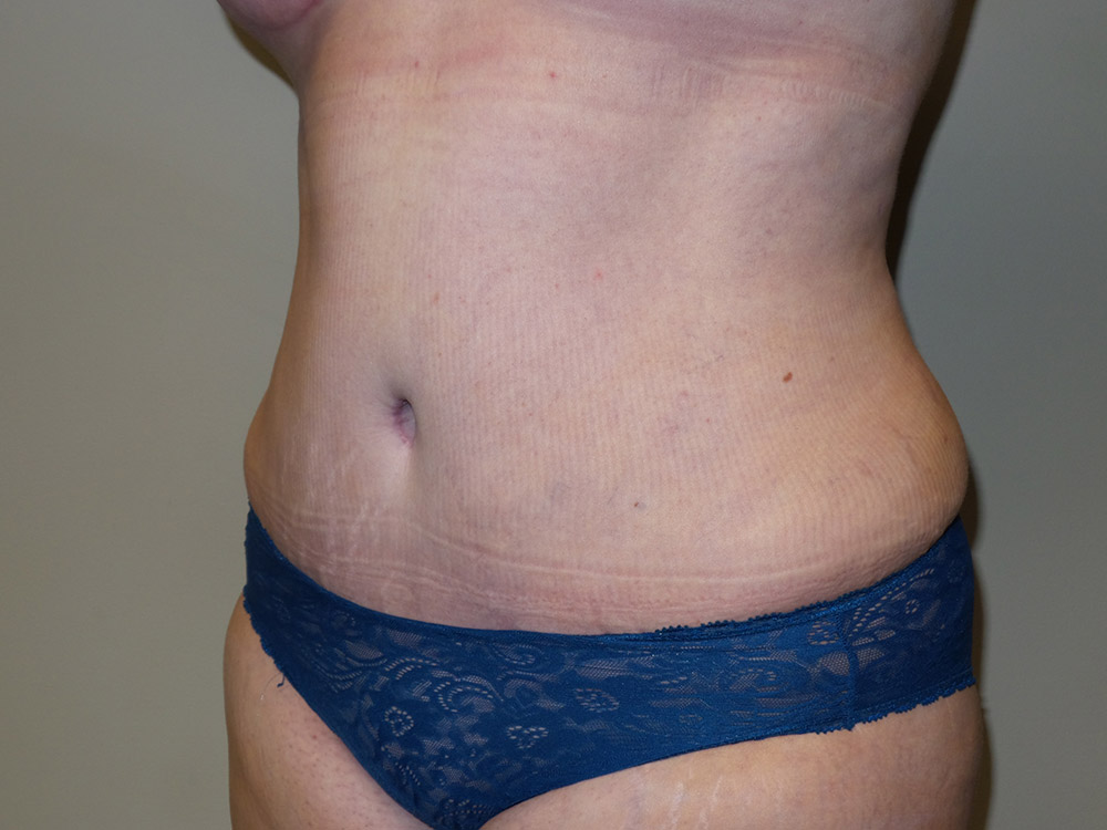 Tummy Tuck Before and After 20 | Sanjay Grover MD FACS