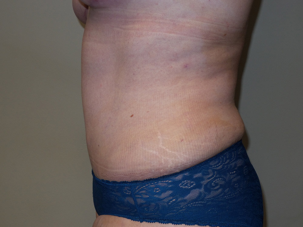 Tummy Tuck Before and After 20 | Grover Aesthetics