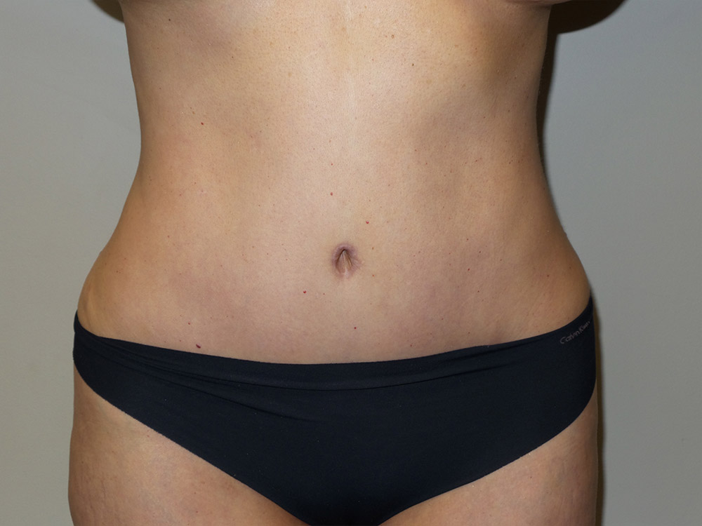 Tummy Tuck Before and After | Grover Aesthetics