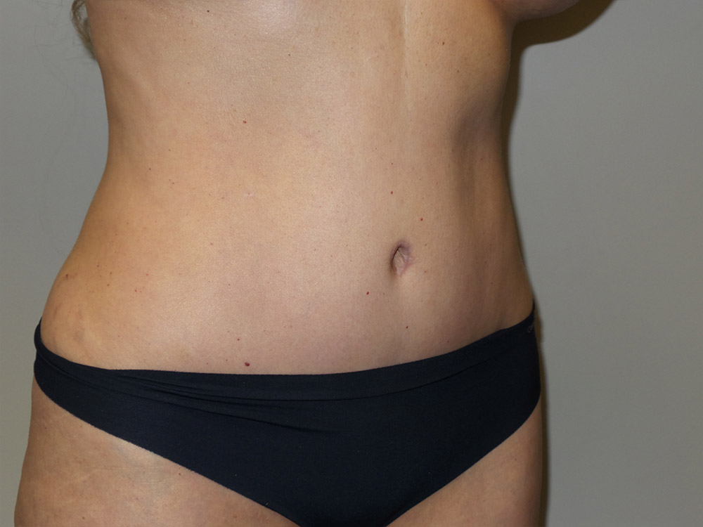 Tummy Tuck Before and After 21 | Grover Aesthetics