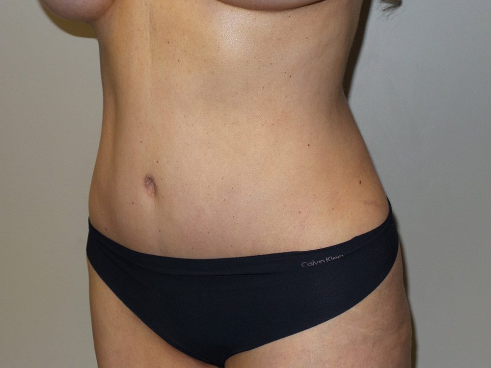 Tummy Tuck Before and After 21 | Sanjay Grover MD FACS