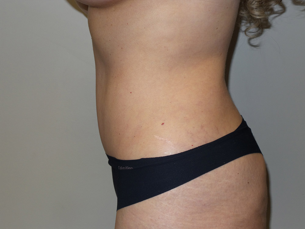 Tummy Tuck Before and After 21 | Sanjay Grover MD FACS