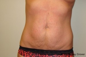 Tummy Tuck Before and After | Grover Aesthetics