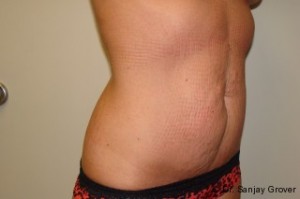 Tummy Tuck Before and After 23 | Grover Aesthetics