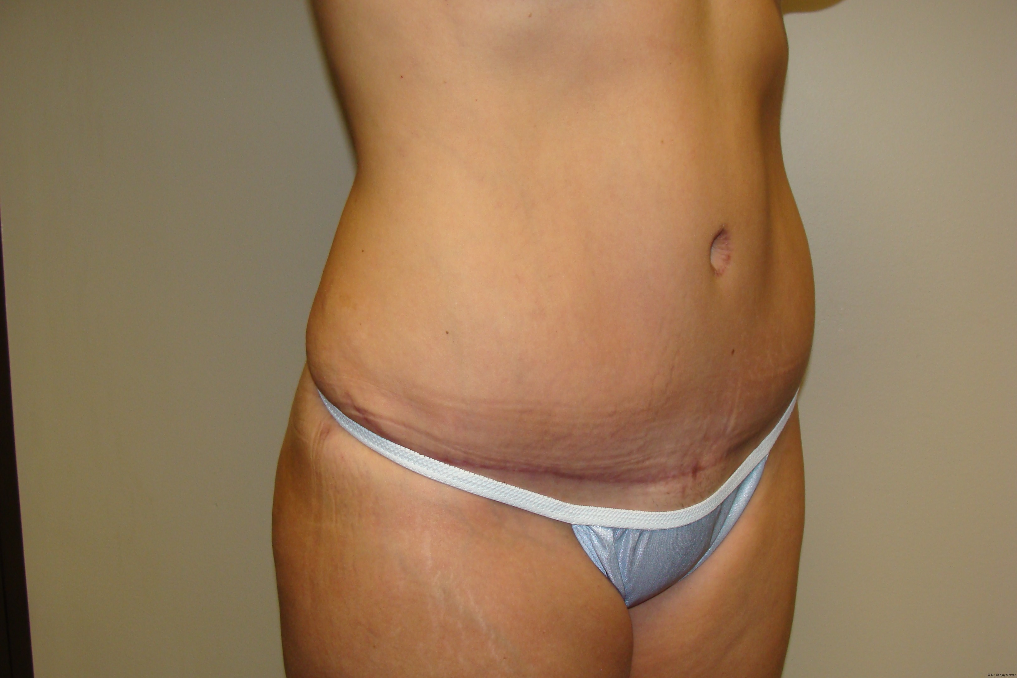 Tummy Tuck Before and After 23 | Sanjay Grover MD FACS