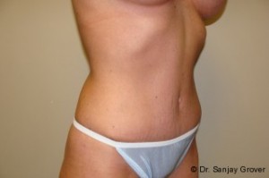 Tummy Tuck Before and After 23 | Grover Aesthetics