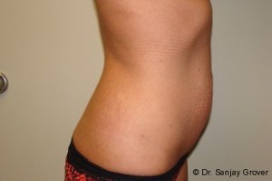 Tummy Tuck Before and After 23 | Grover Aesthetics