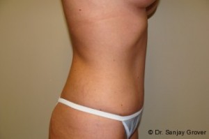 Tummy Tuck Before and After 23 | Sanjay Grover MD FACS