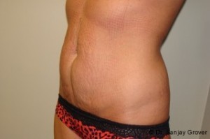 Tummy Tuck Before and After 23 | Sanjay Grover MD FACS