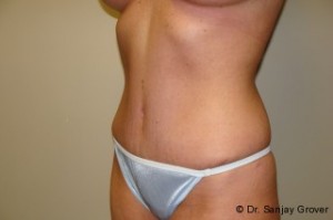 Tummy Tuck Before and After 23 | Grover Aesthetics