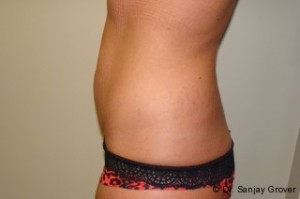 Tummy Tuck Before and After 23 | Grover Aesthetics