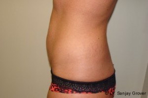 Tummy Tuck Before and After 23 | Sanjay Grover MD FACS