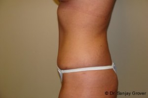 Tummy Tuck Before and After 23 | Grover Aesthetics