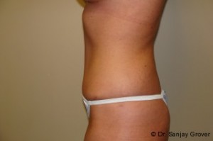 Tummy Tuck Before and After 23 | Sanjay Grover MD FACS