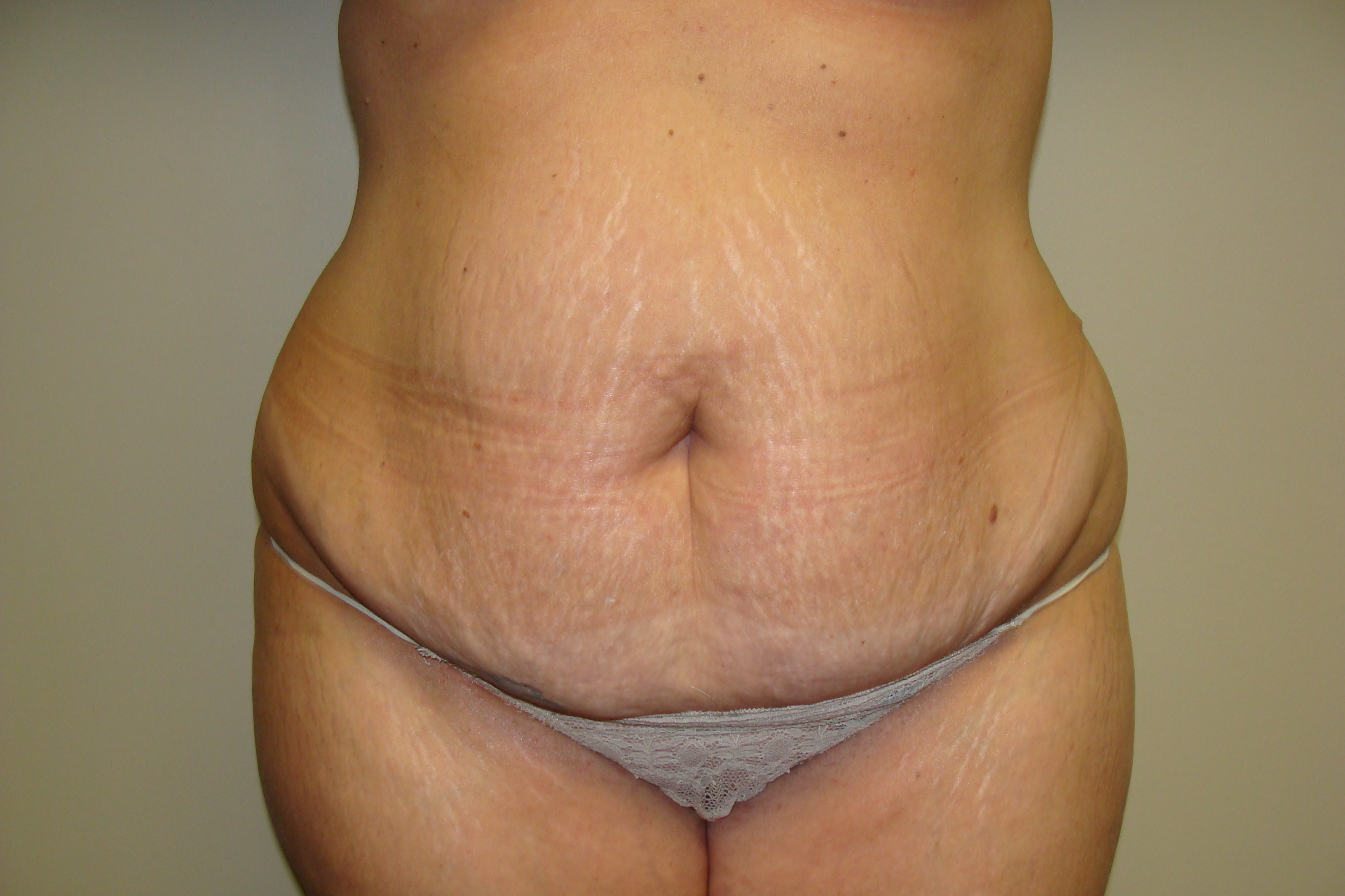 Tummy Tuck Before and After | Grover Aesthetics