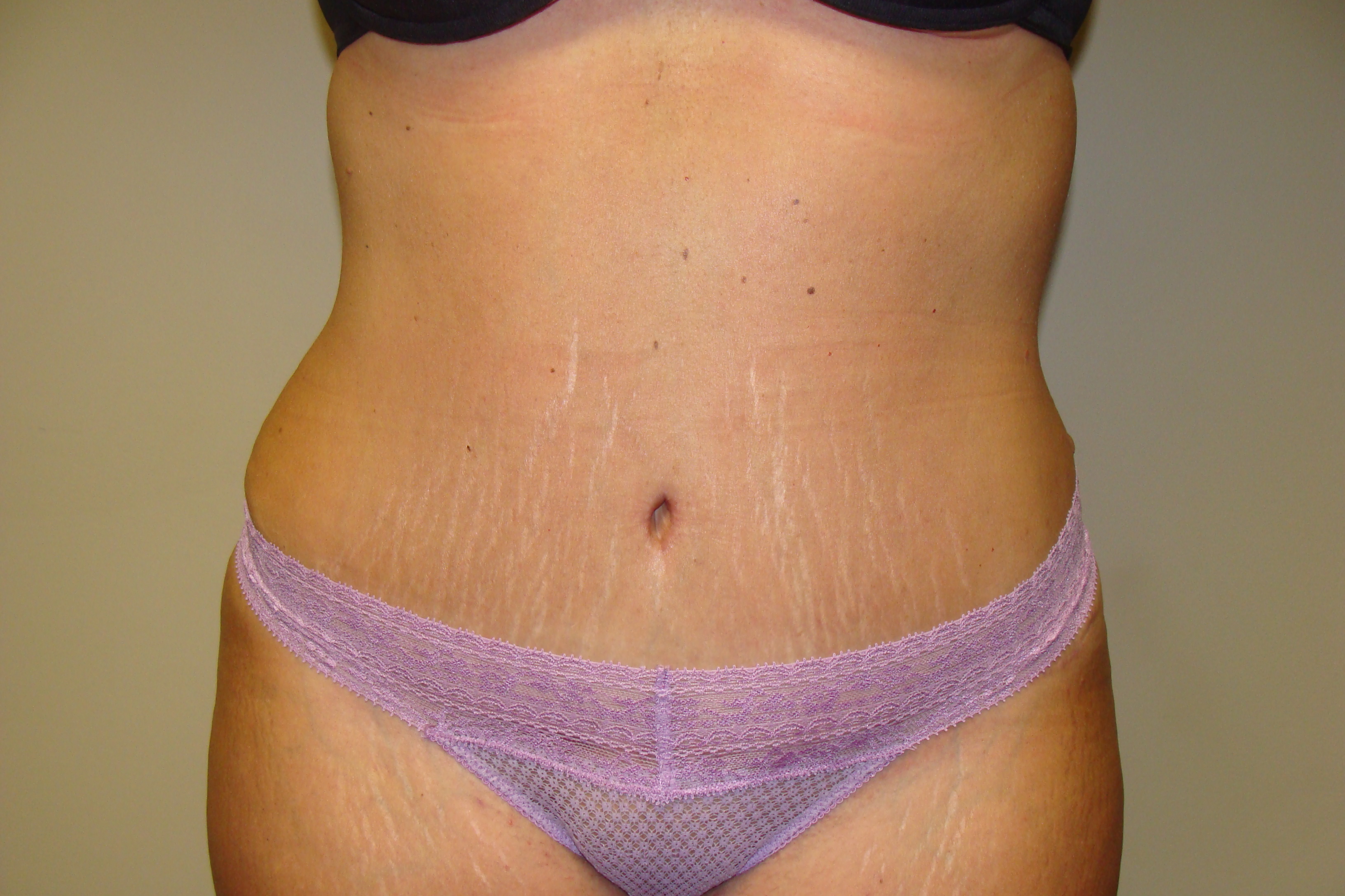 Tummy Tuck Before and After | Grover Aesthetics