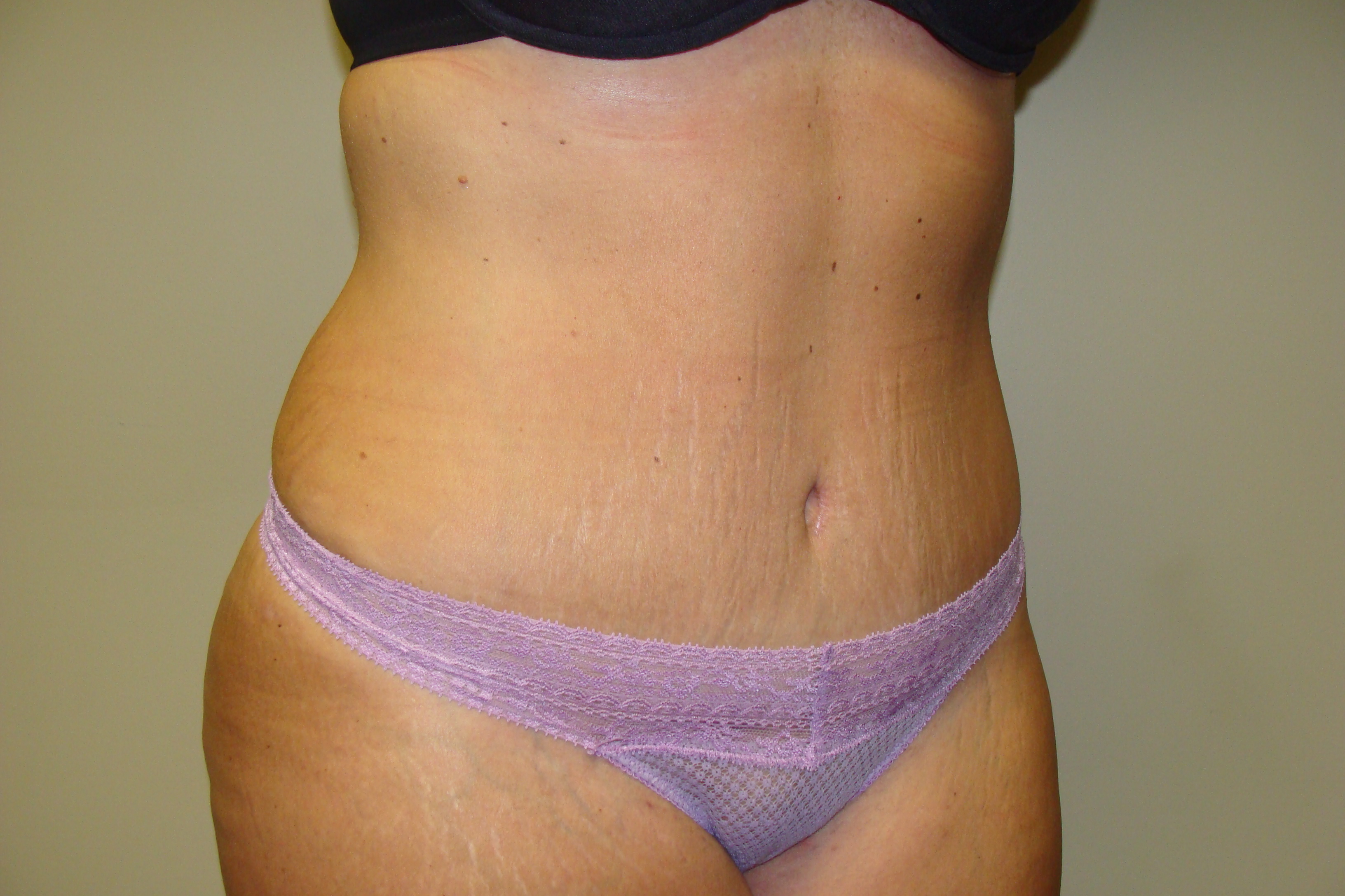 Tummy Tuck Before and After 24 | Sanjay Grover MD FACS