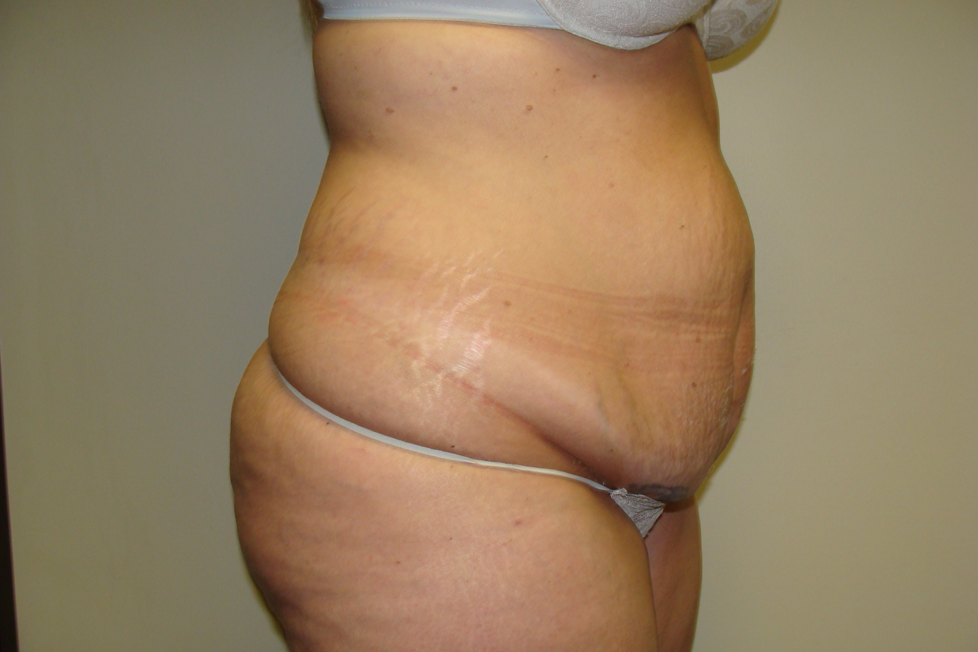 Tummy Tuck Before and After 24 | Sanjay Grover MD FACS