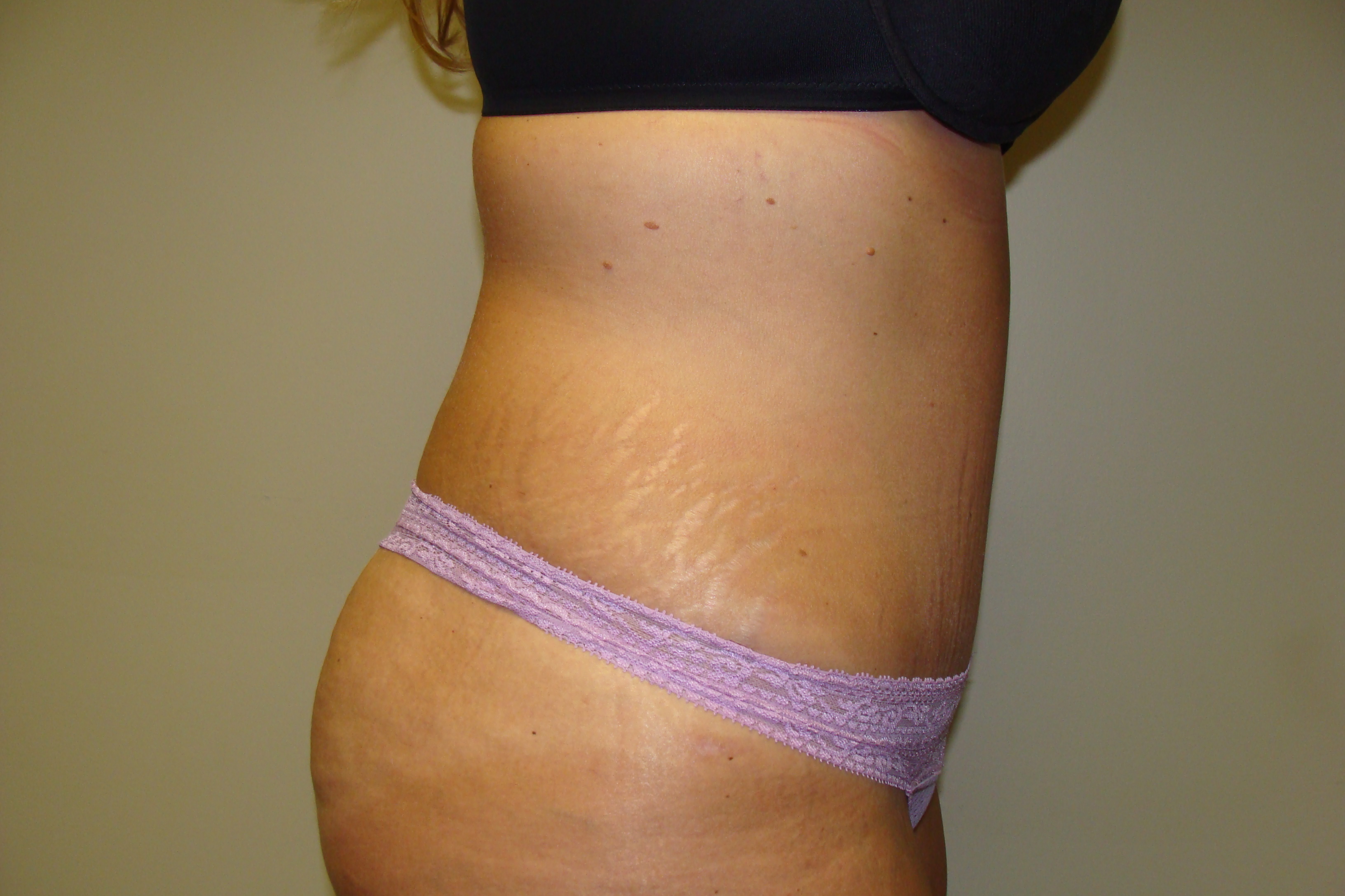 Tummy Tuck Before and After 24 | Sanjay Grover MD FACS