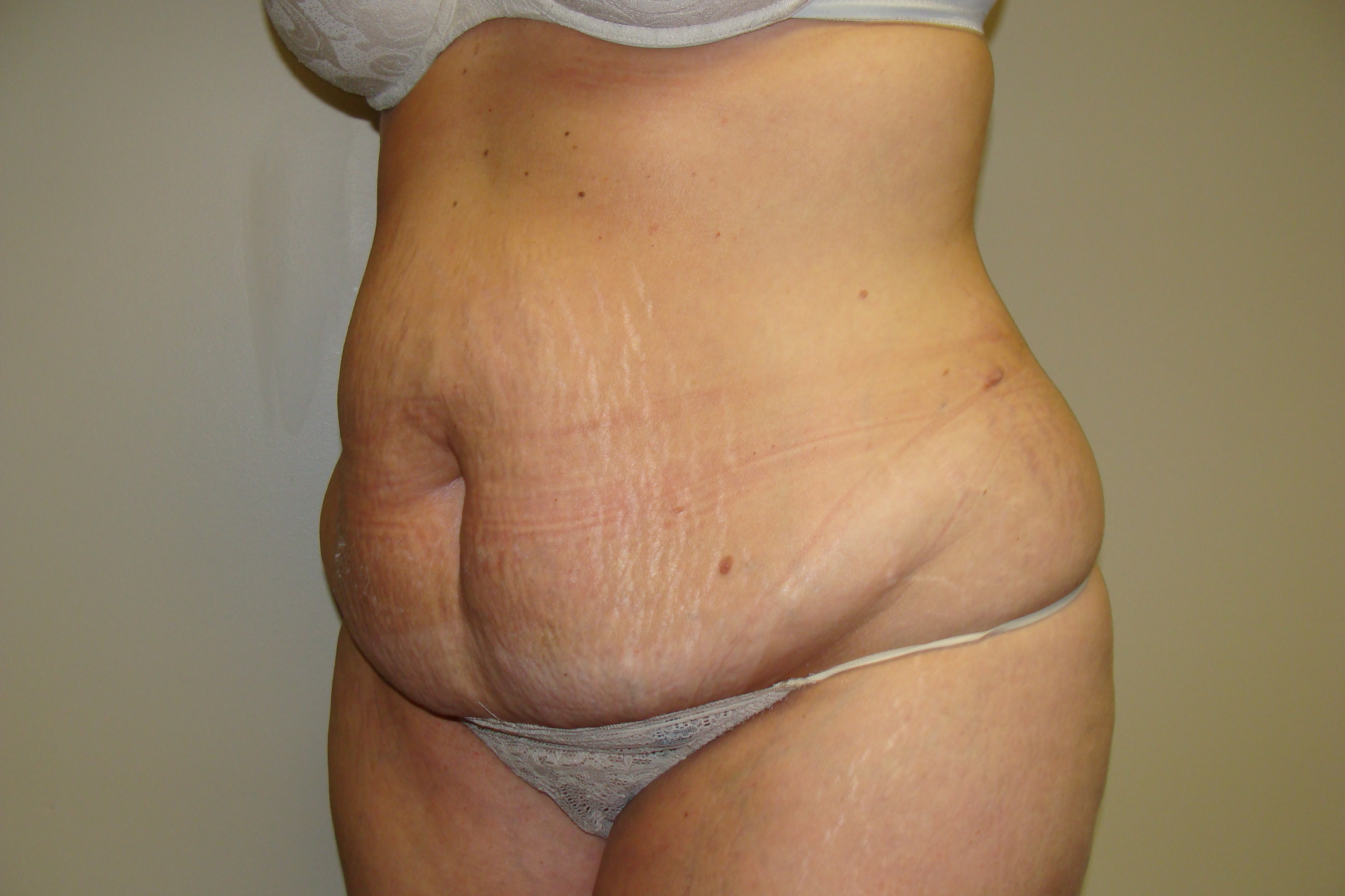 Tummy Tuck Before and After 24 | Sanjay Grover MD FACS