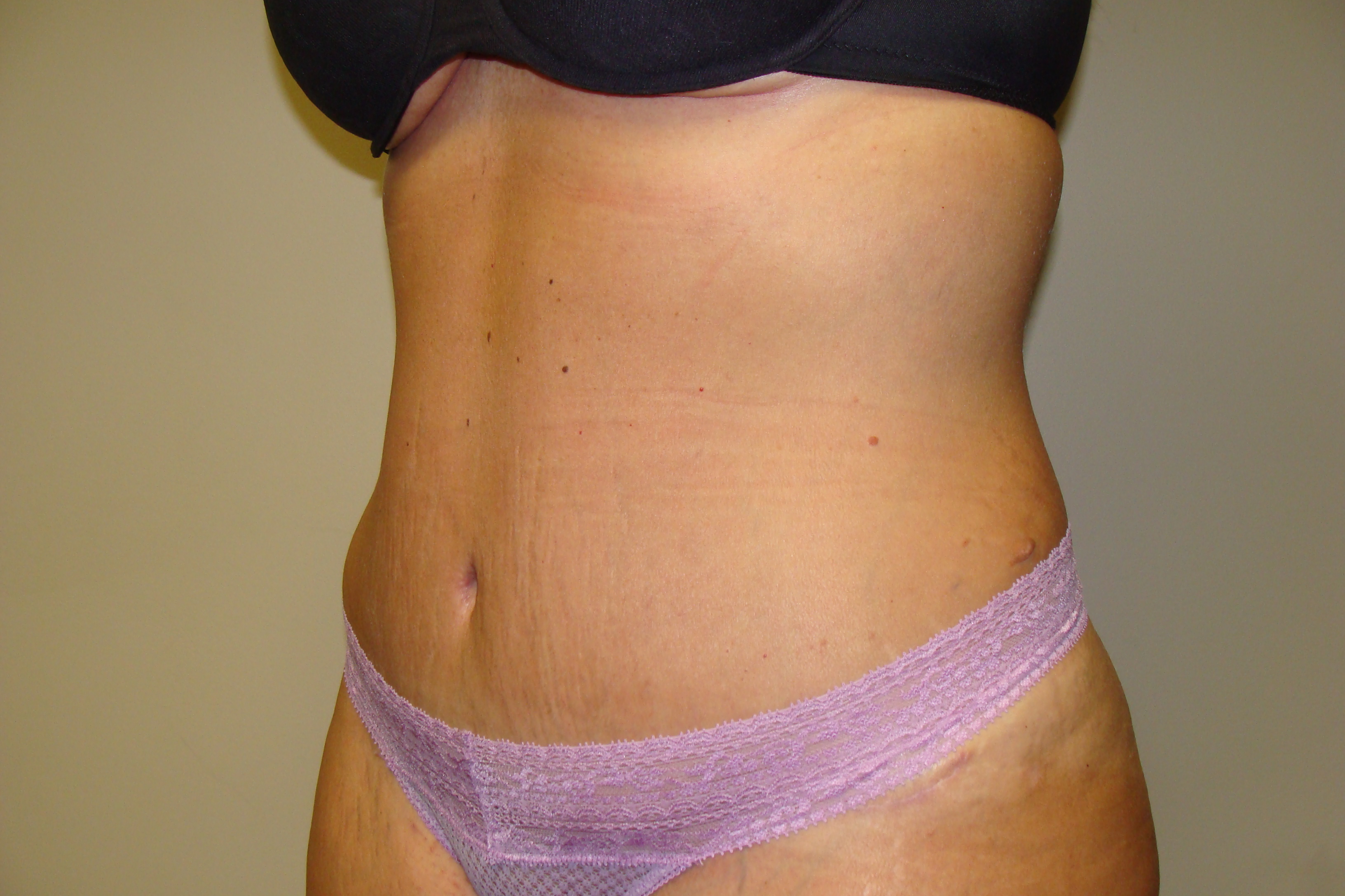 Tummy Tuck Before and After 24 | Sanjay Grover MD FACS