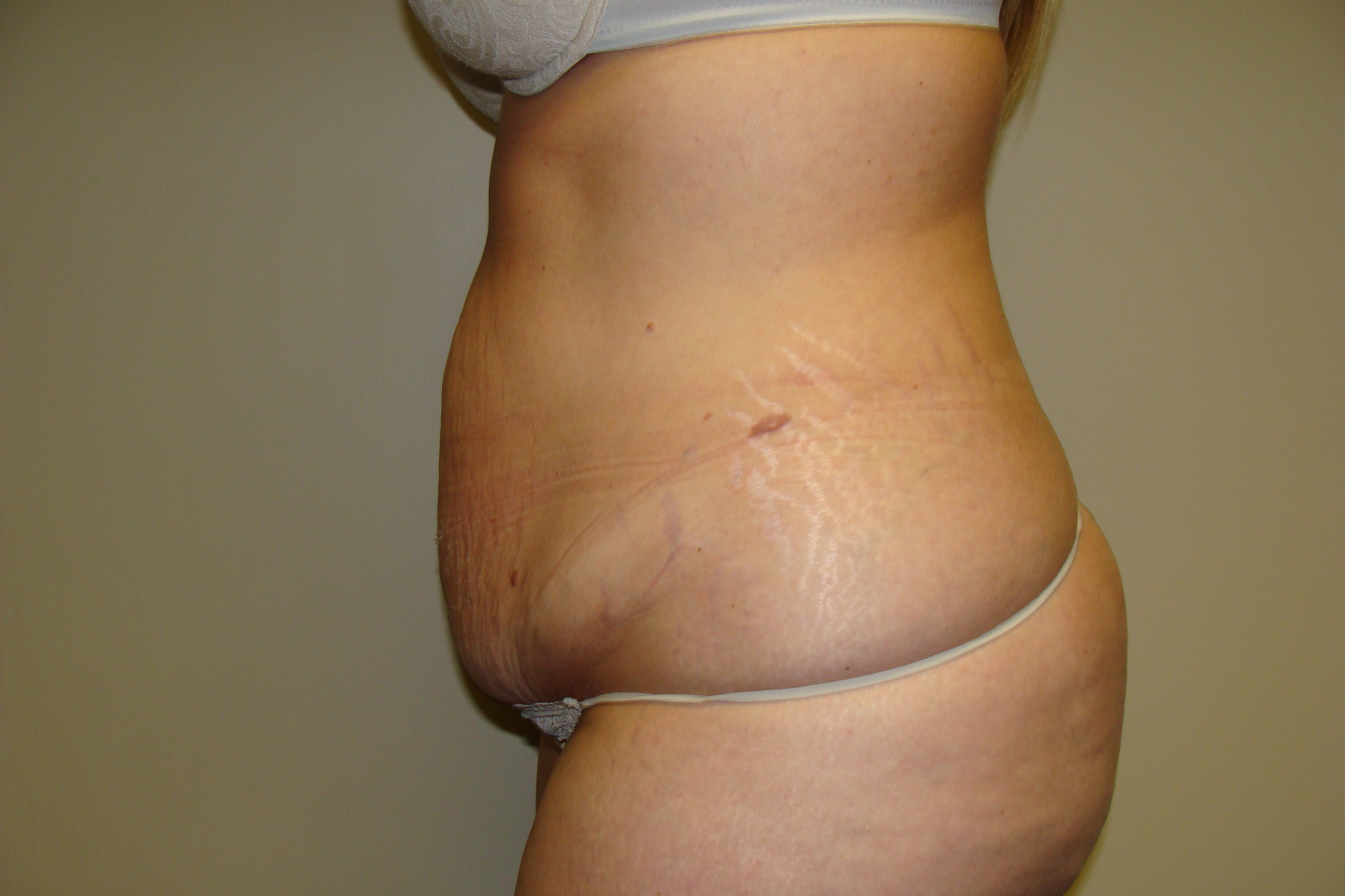 Tummy Tuck Before and After 24 | Sanjay Grover MD FACS