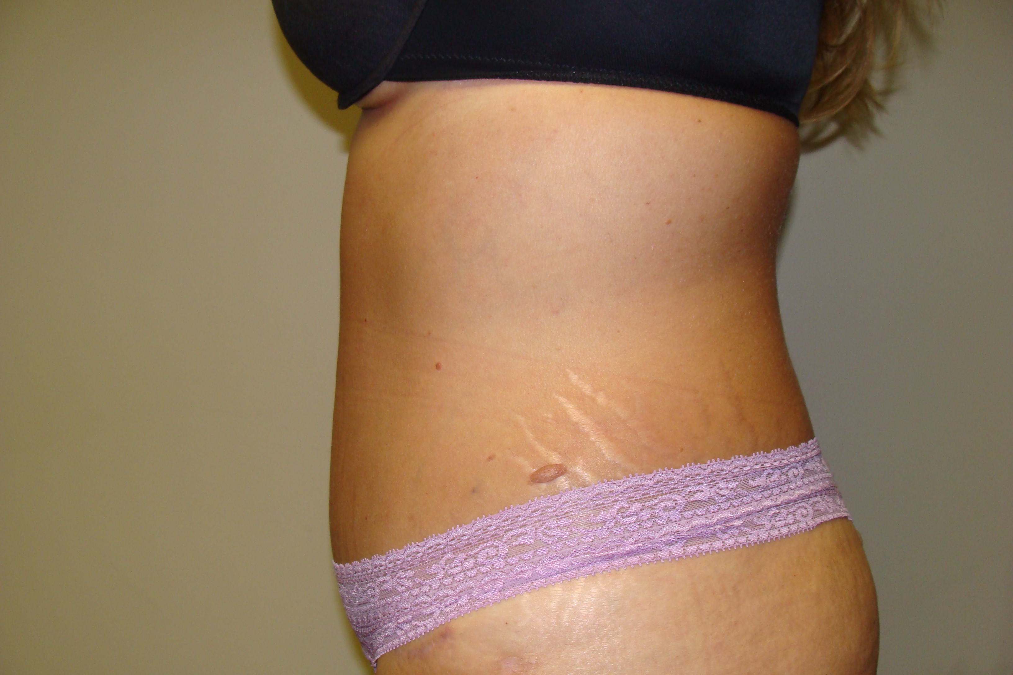 Tummy Tuck Before and After 24 | Sanjay Grover MD FACS