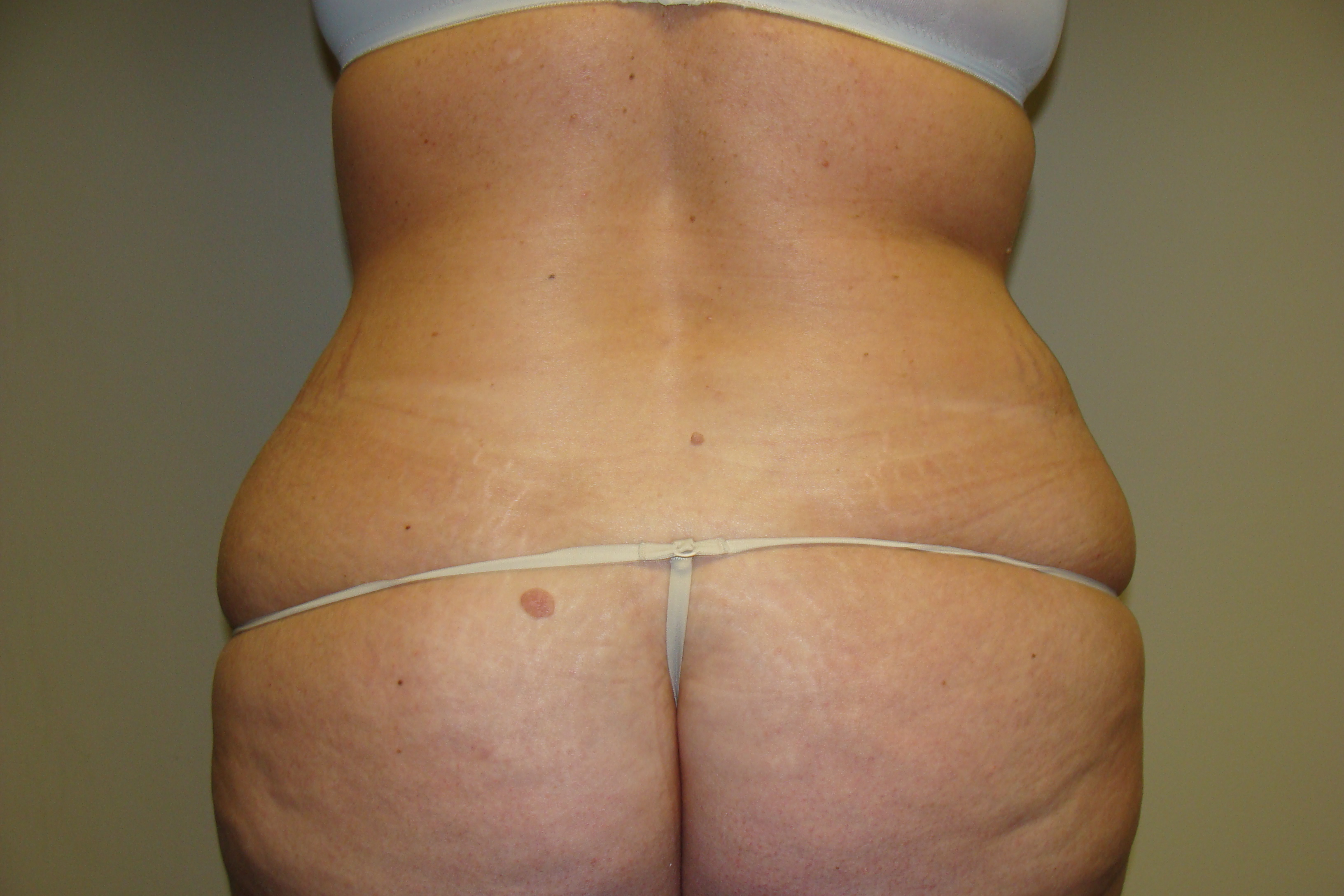Tummy Tuck Before and After 24 | Grover Aesthetics