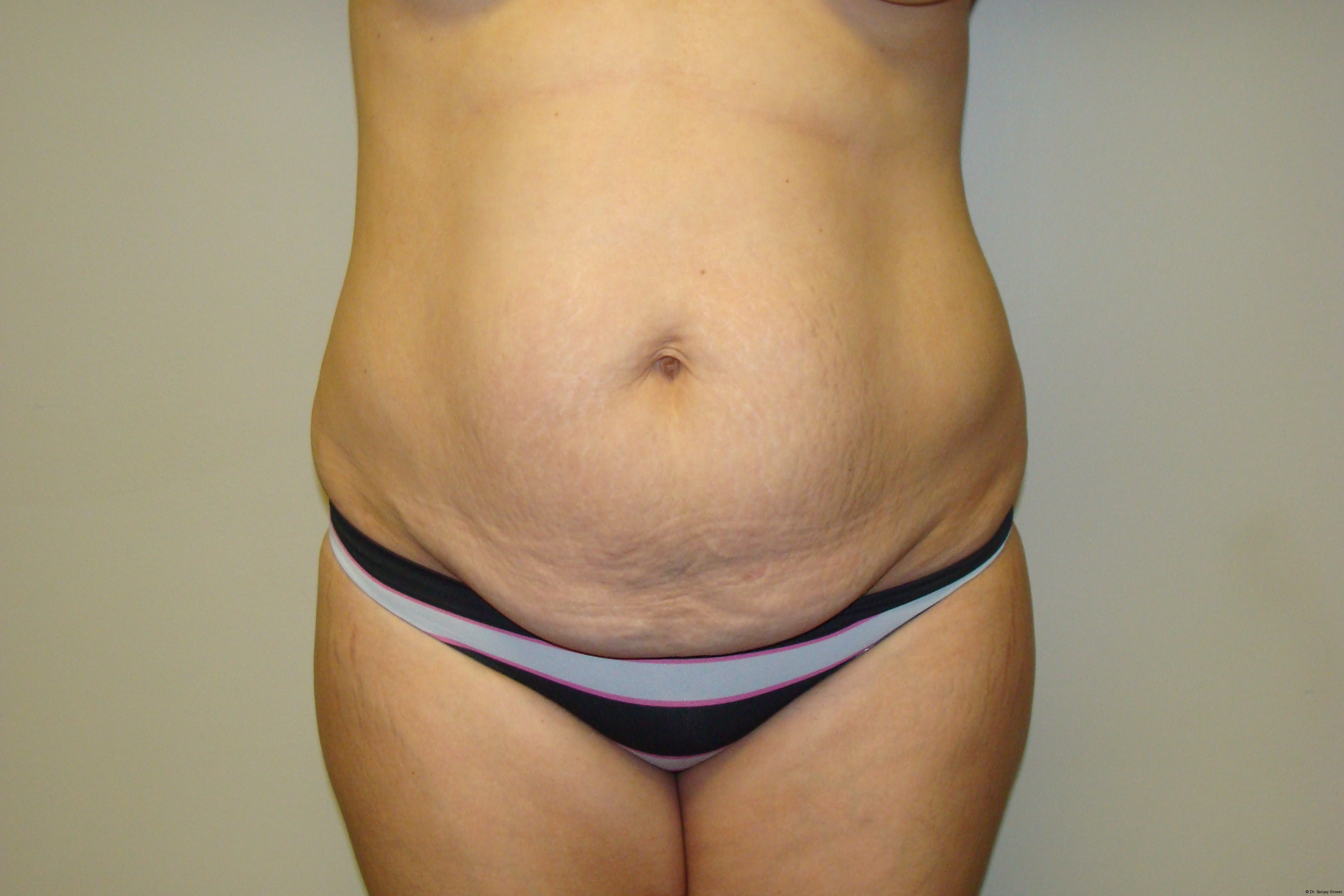 Tummy Tuck Before and After | Grover Aesthetics