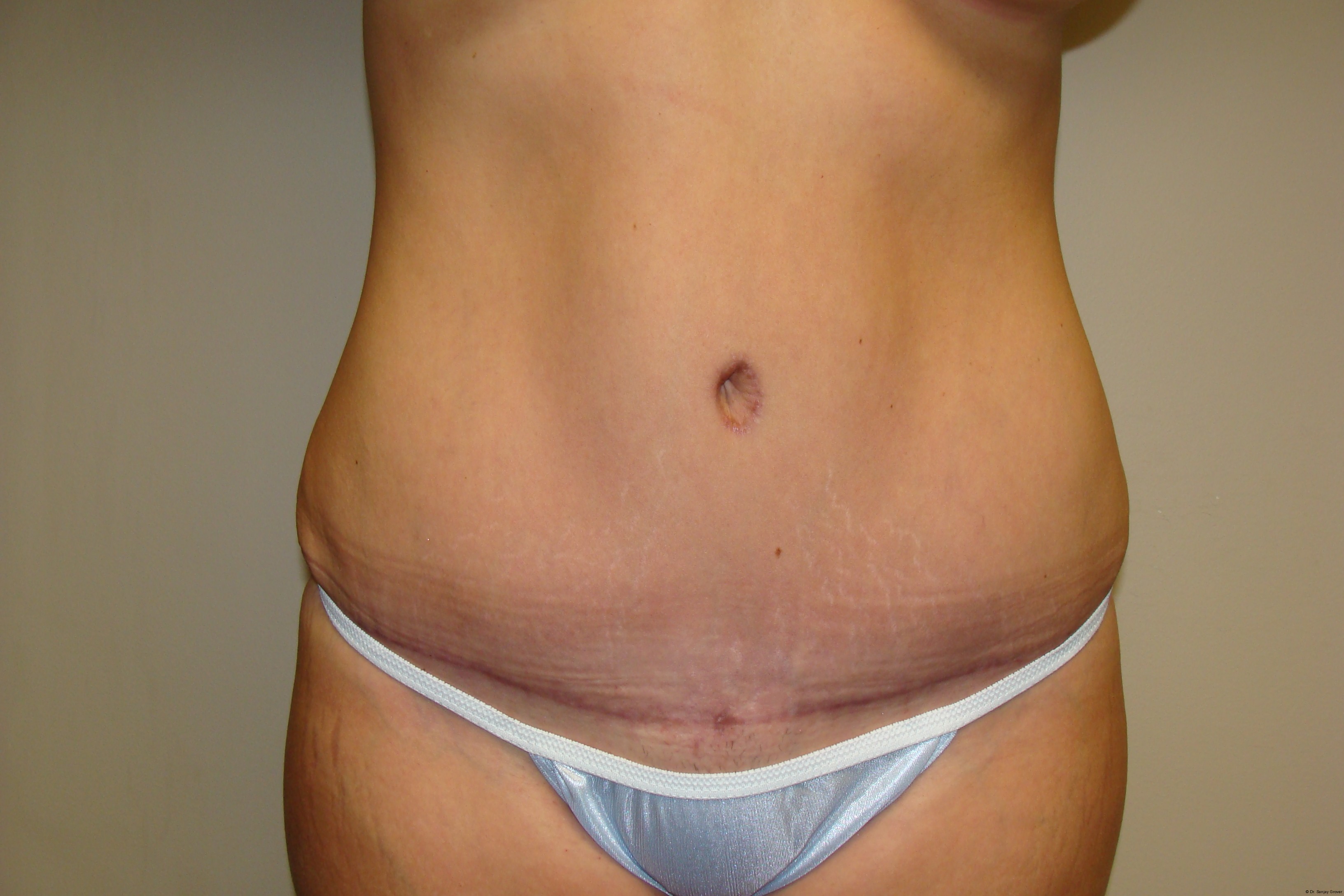 Tummy Tuck Before and After | Grover Aesthetics