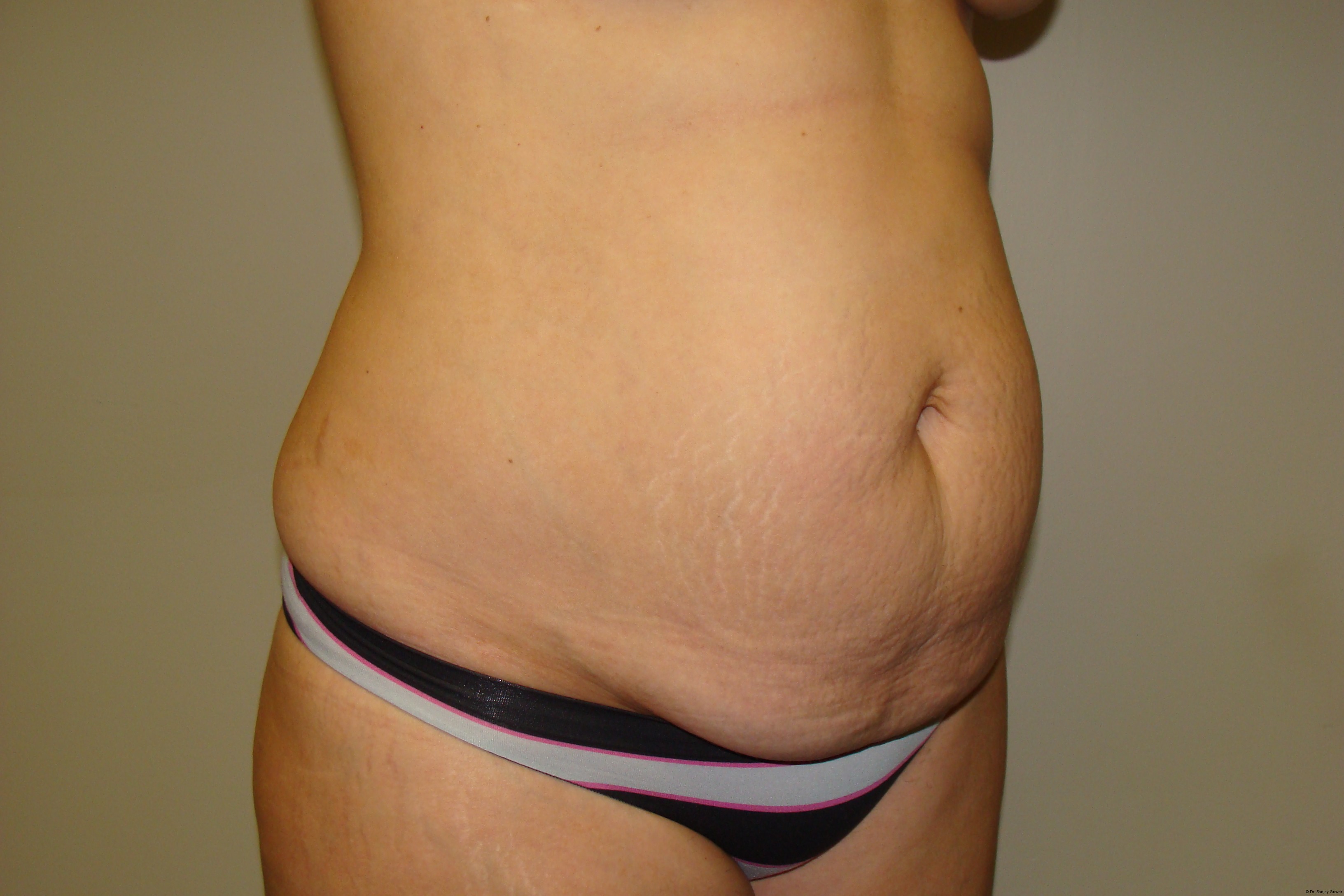 Tummy Tuck Before and After 25 | Sanjay Grover MD FACS