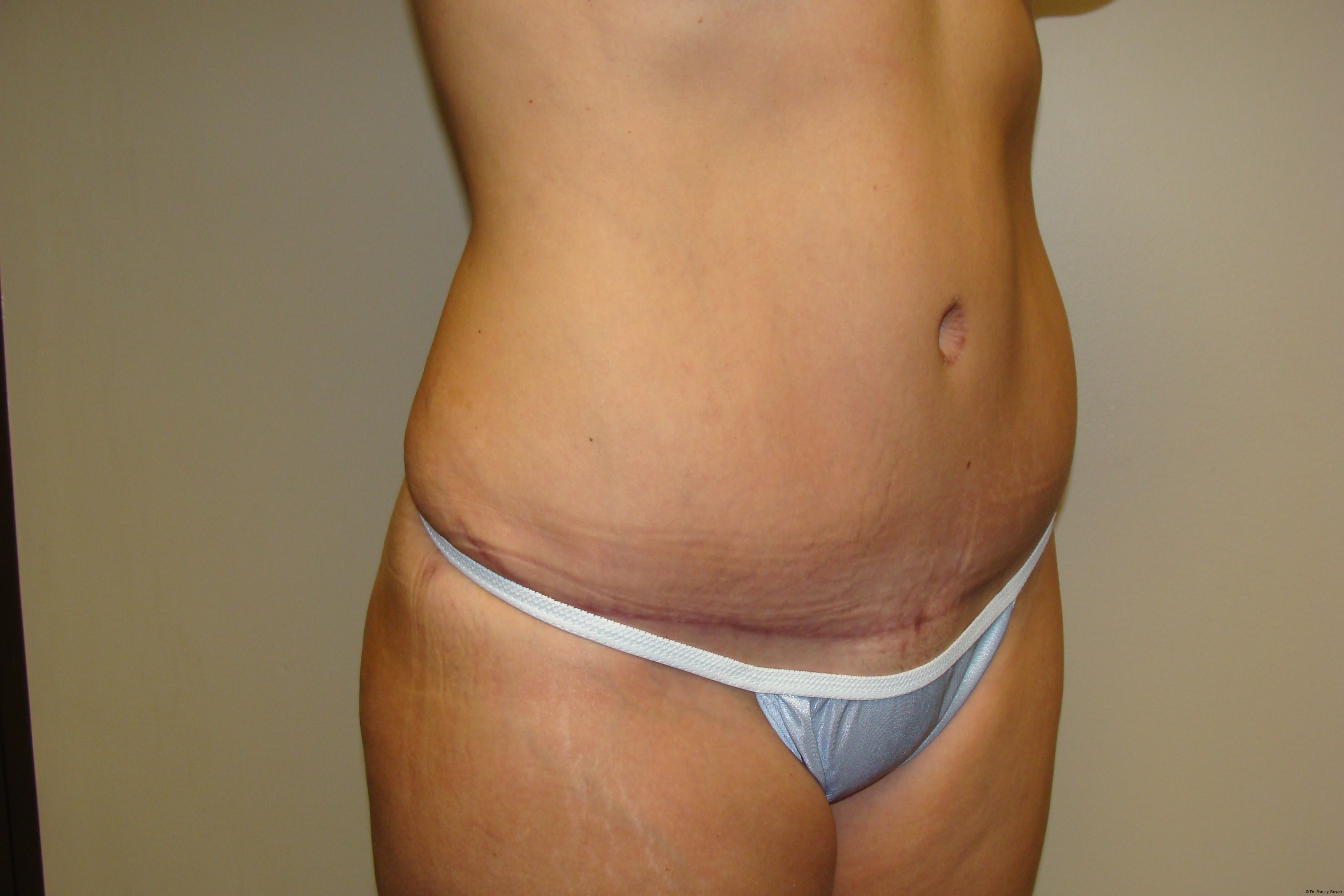 Tummy Tuck Before and After 25 | Sanjay Grover MD FACS