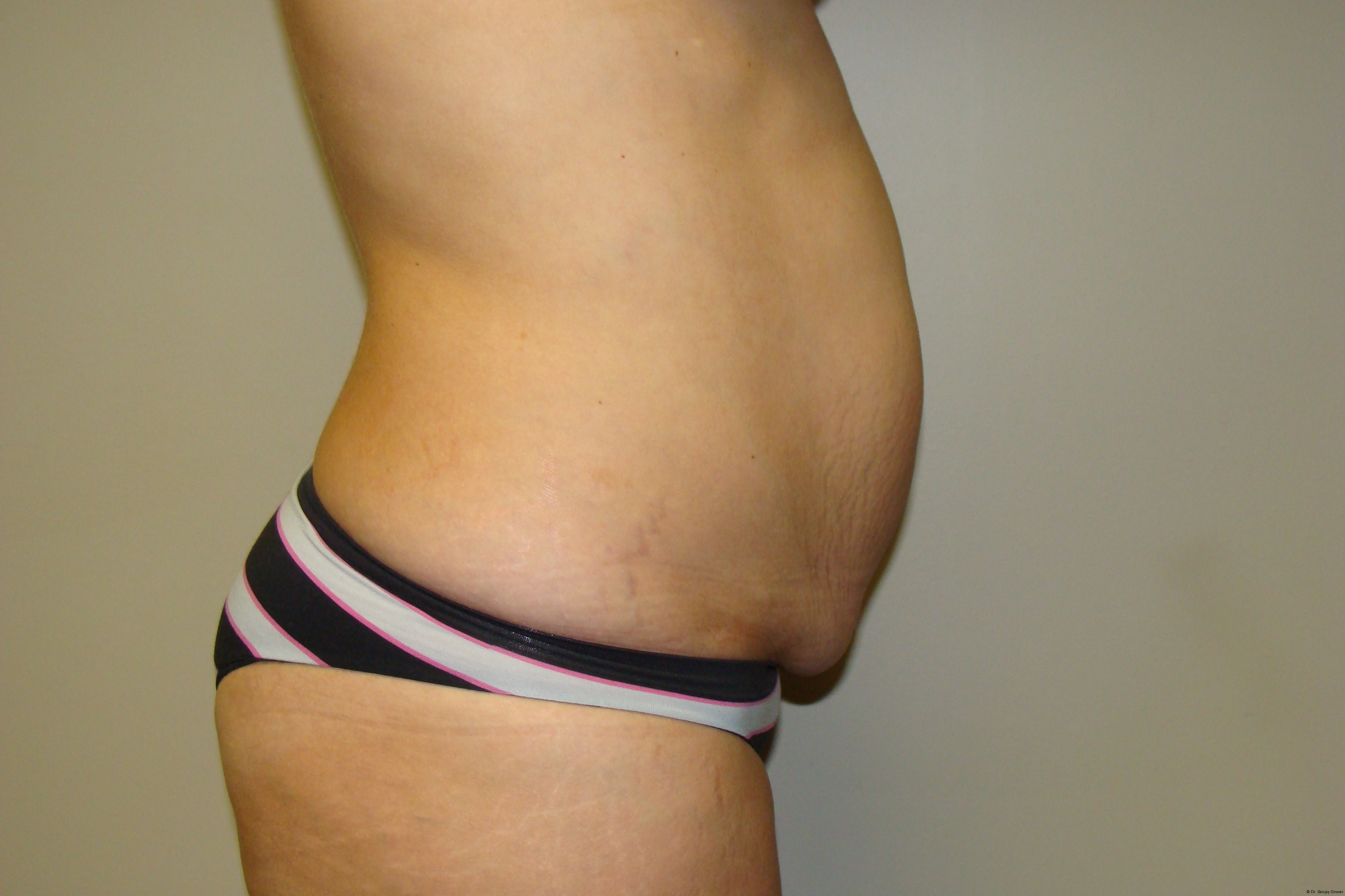 Tummy Tuck Before and After 25 | Sanjay Grover MD FACS