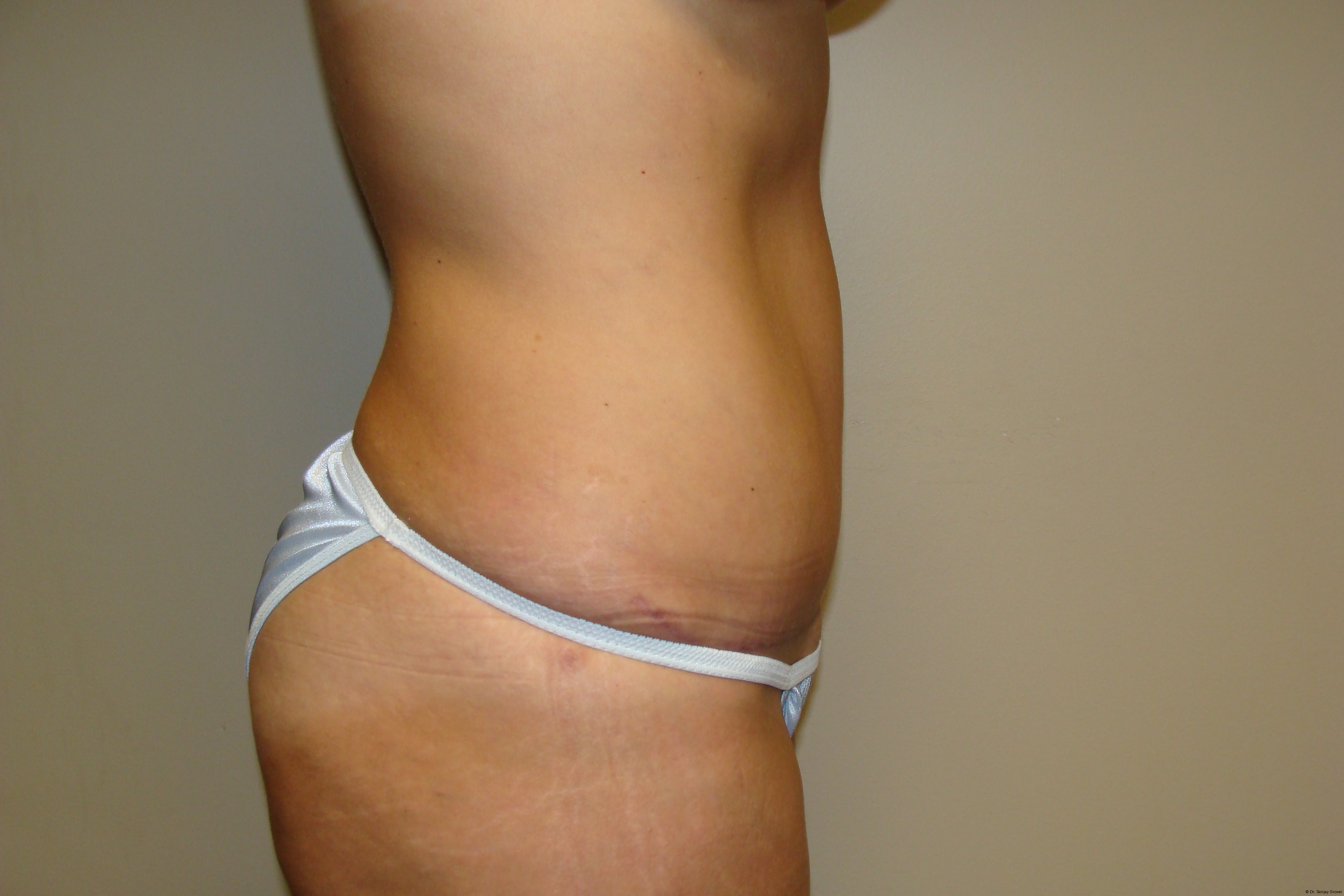 Tummy Tuck Before and After 25 | Sanjay Grover MD FACS