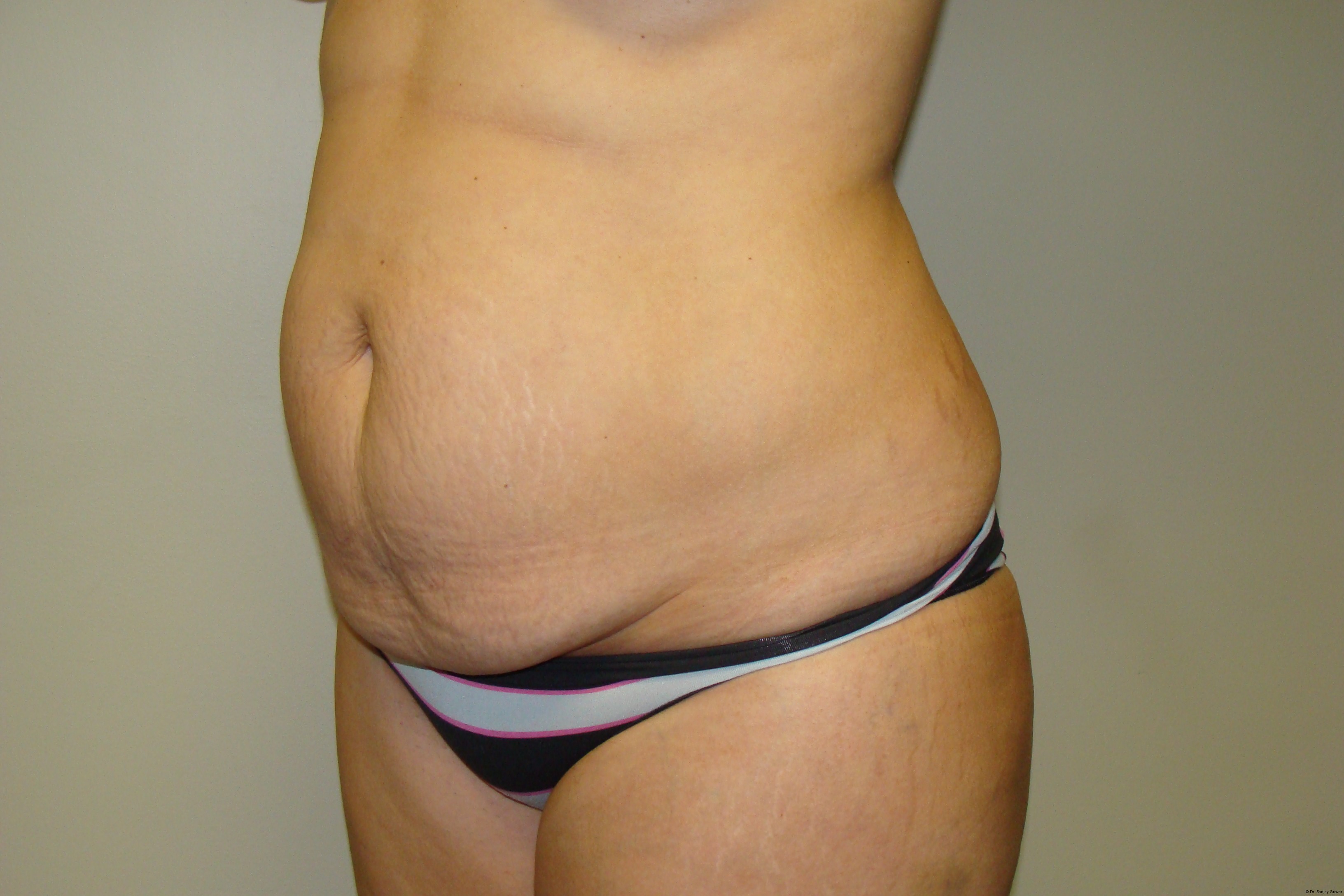 Tummy Tuck Before and After 25 | Grover Aesthetics