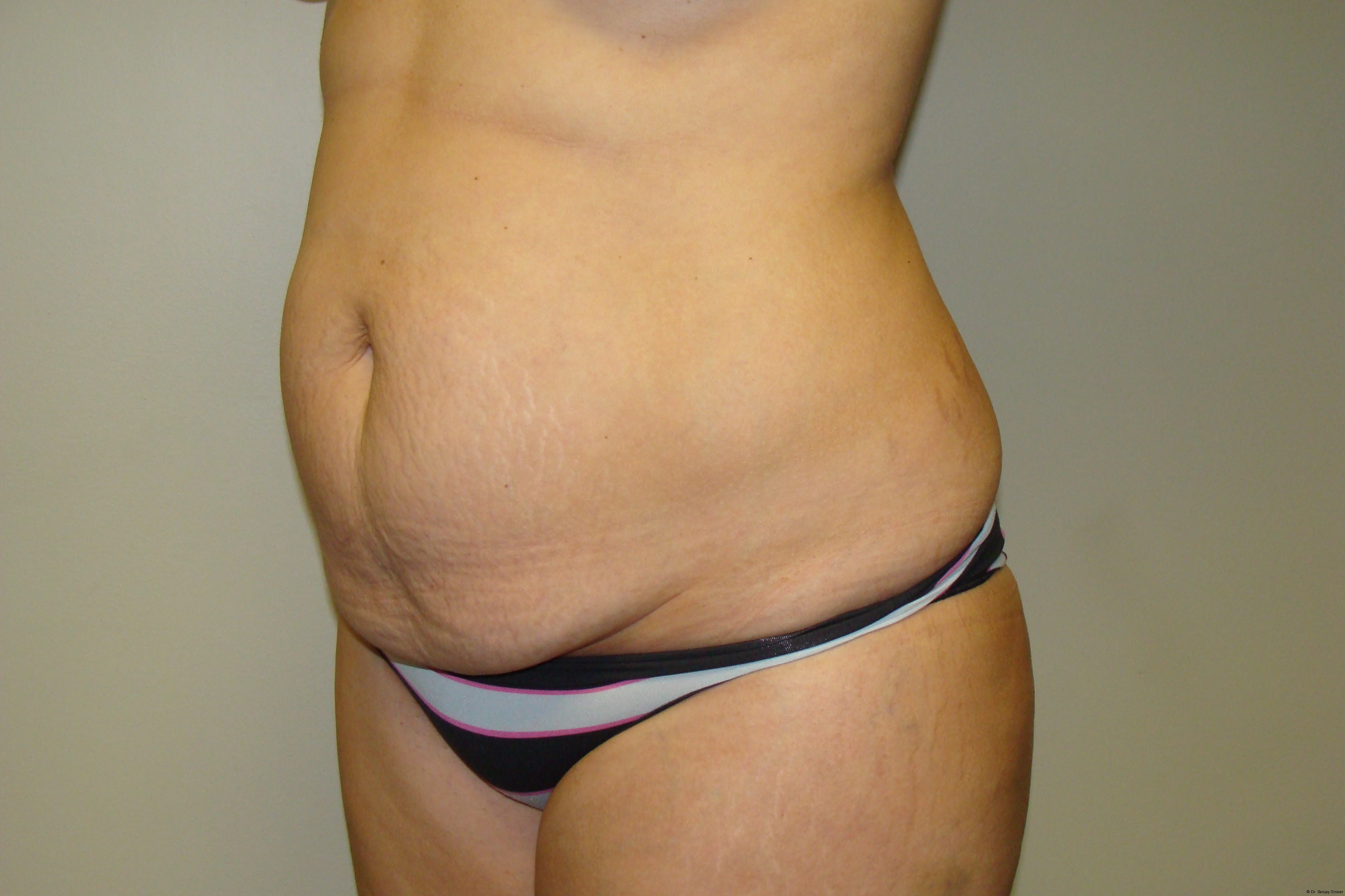 Tummy Tuck Before and After 25 | Sanjay Grover MD FACS