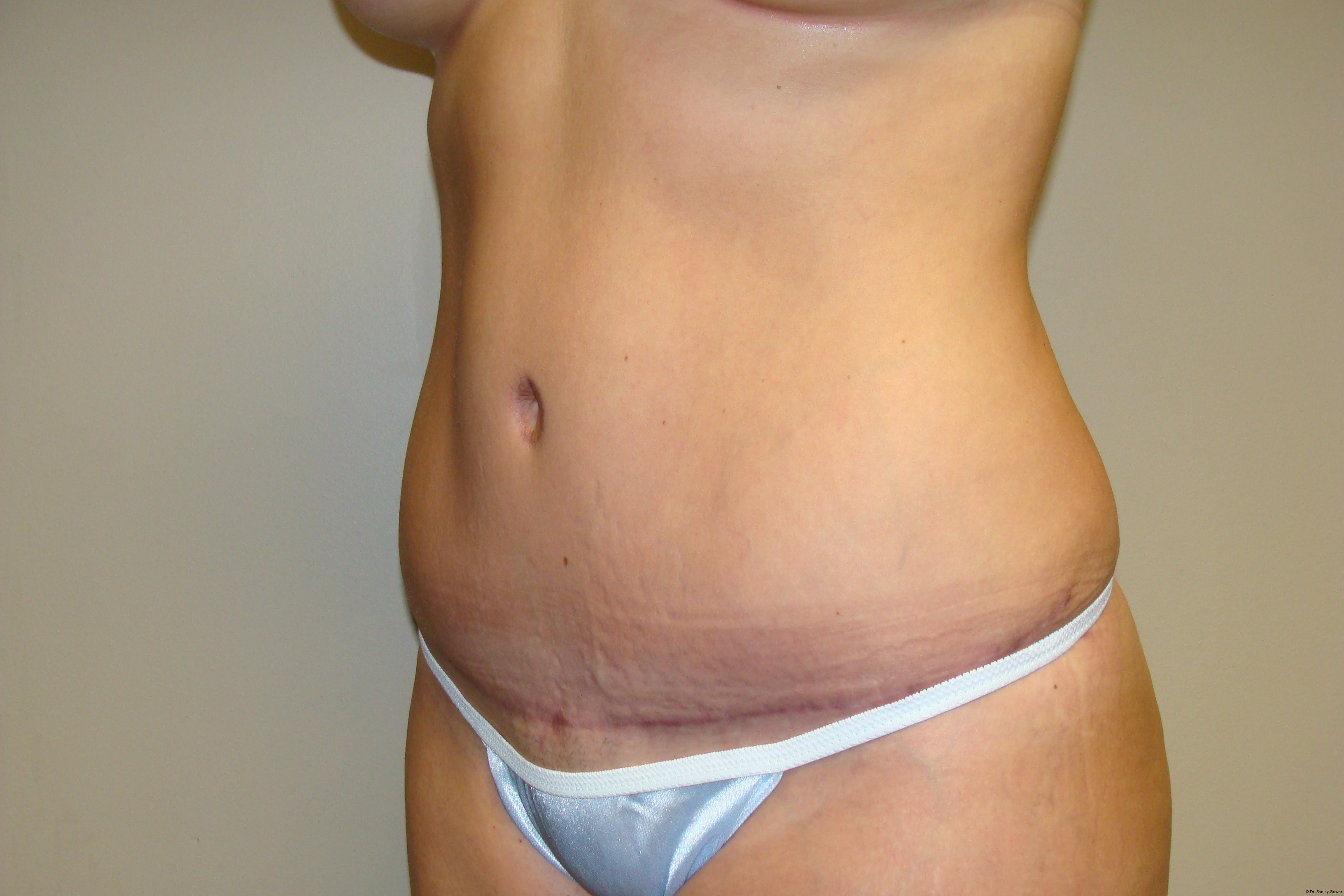 Tummy Tuck Before and After 25 | Sanjay Grover MD FACS