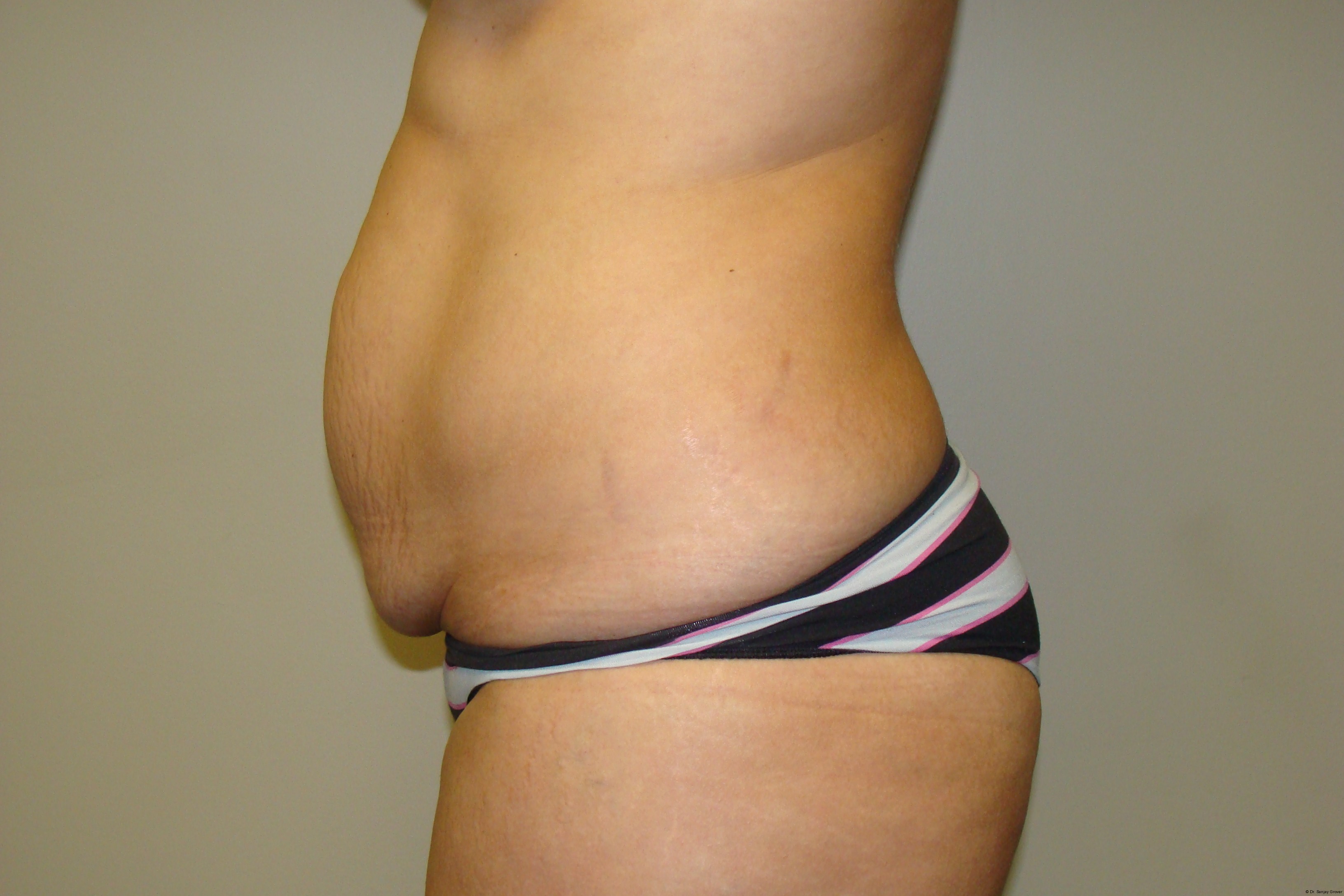 Tummy Tuck Before and After 25 | Sanjay Grover MD FACS