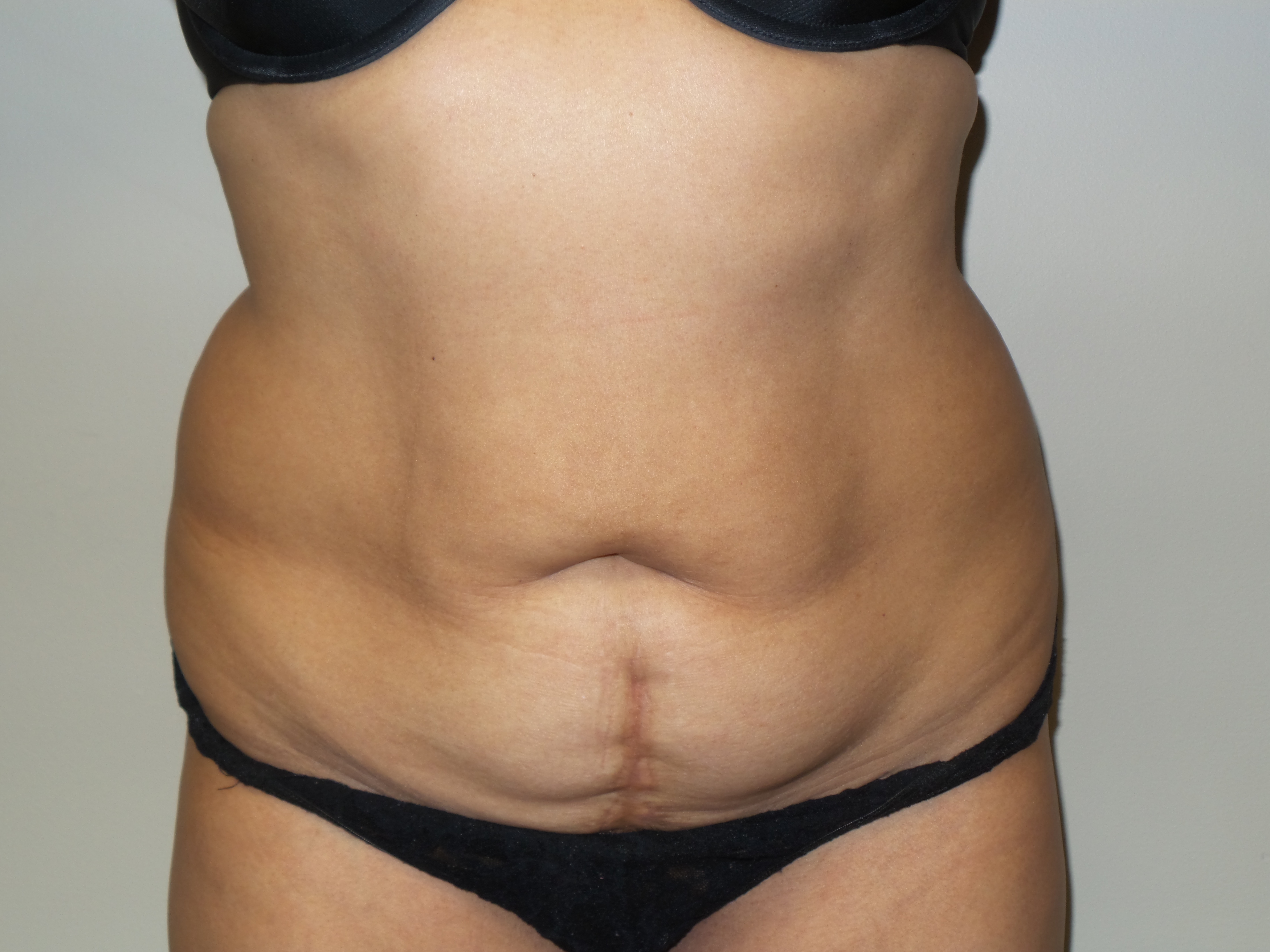 Tummy Tuck Before and After | Grover Aesthetics