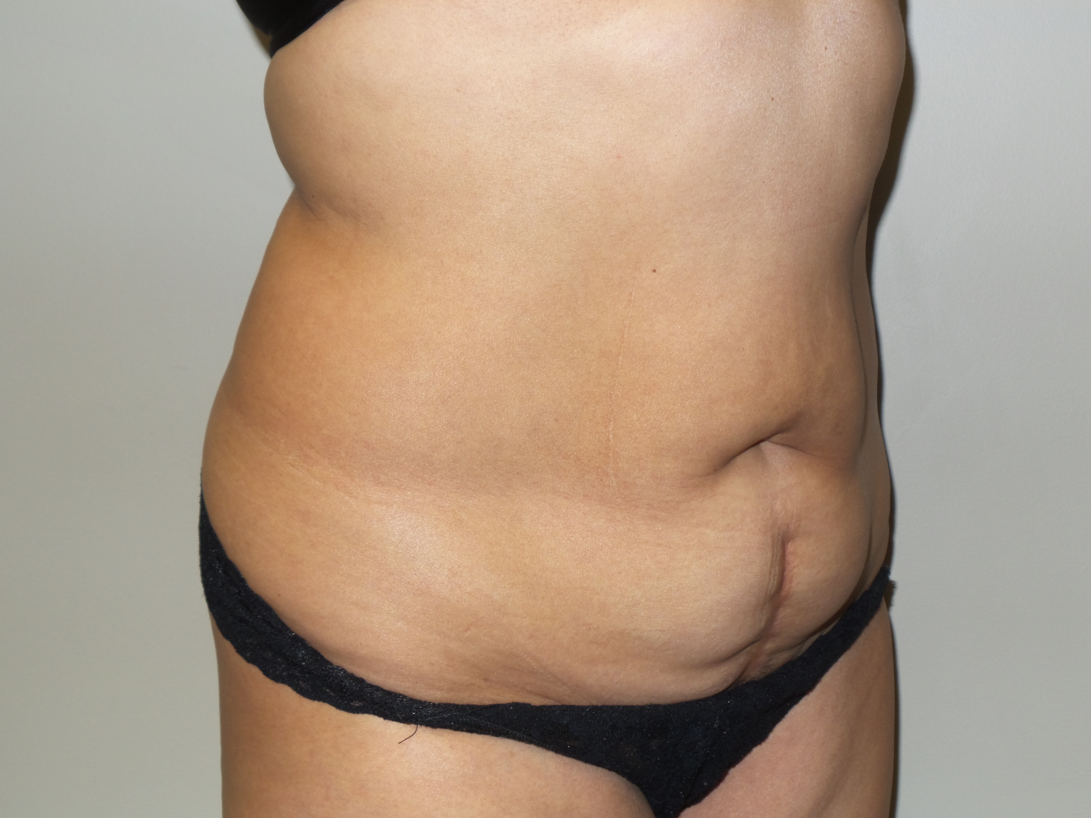 Tummy Tuck Before and After 26 | Sanjay Grover MD FACS